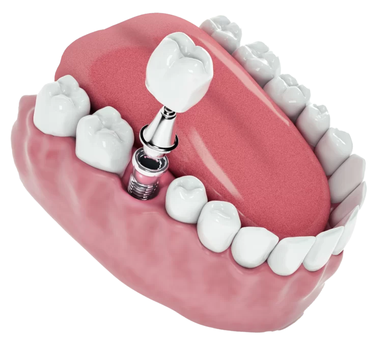 view-from-false-tooth-implant-fixed-jawbone-3d-3d-illustration-768x696_1